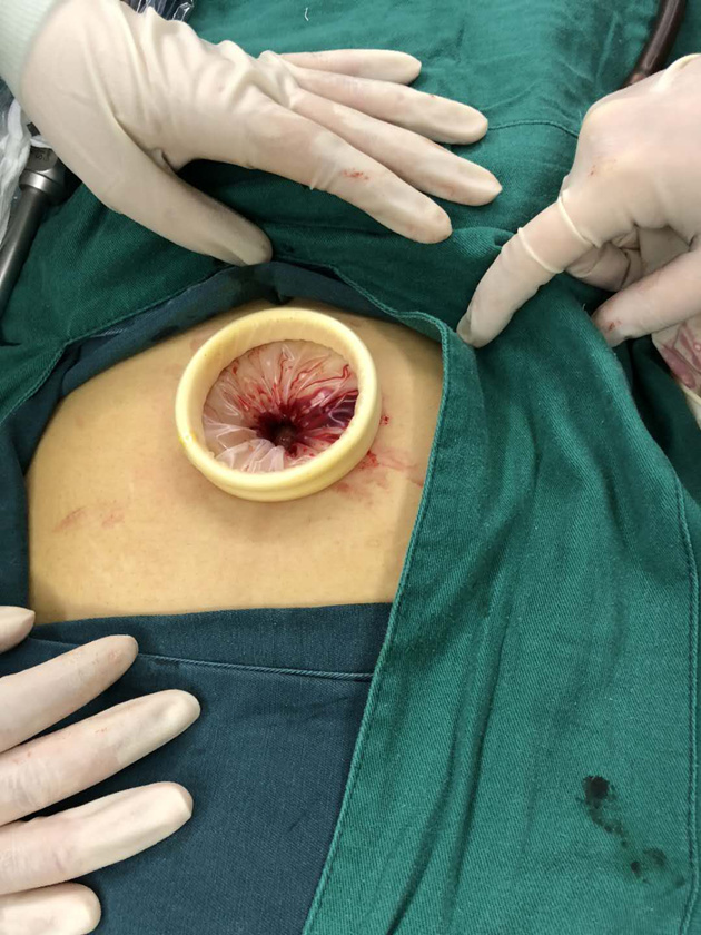 借"道"肚脐终止宫外孕 市中心医院开展首例单孔腹腔镜