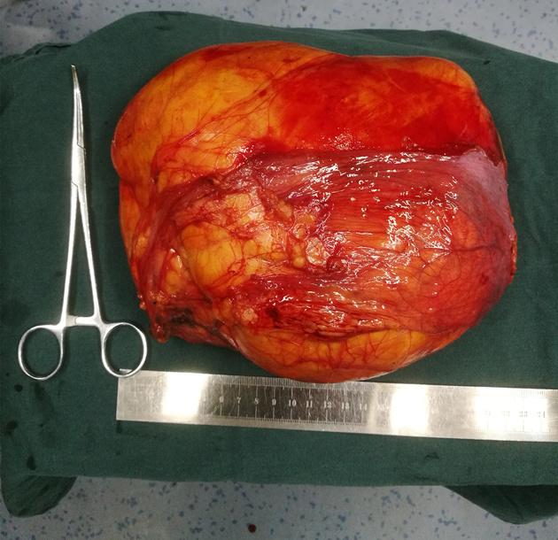 排球大的后腹膜肿瘤 多学科联合手术切除